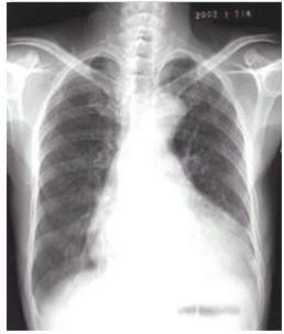 X线-心脏增大