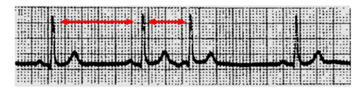 房性期前收縮心電圖表現(xiàn).png