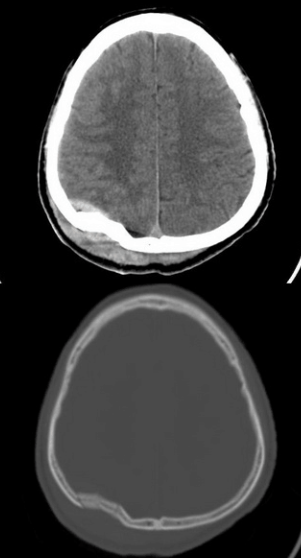 顱骨骨折并硬膜外血腫.png