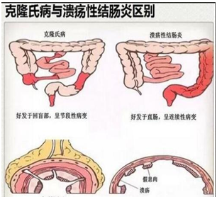 潰瘍性結(jié)腸炎病理.png