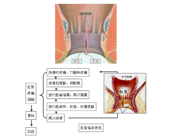肛裂.png