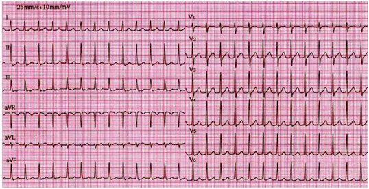 窦性心动过速此心电图诊断为